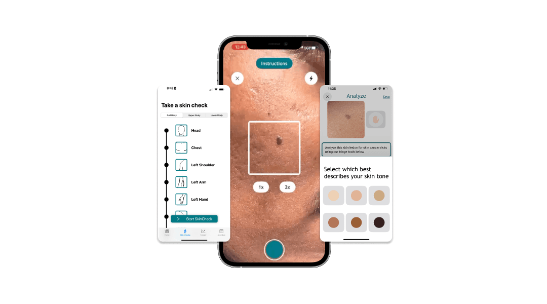 Democratizing Early Skin Cancer Detection